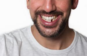 man missing tooth